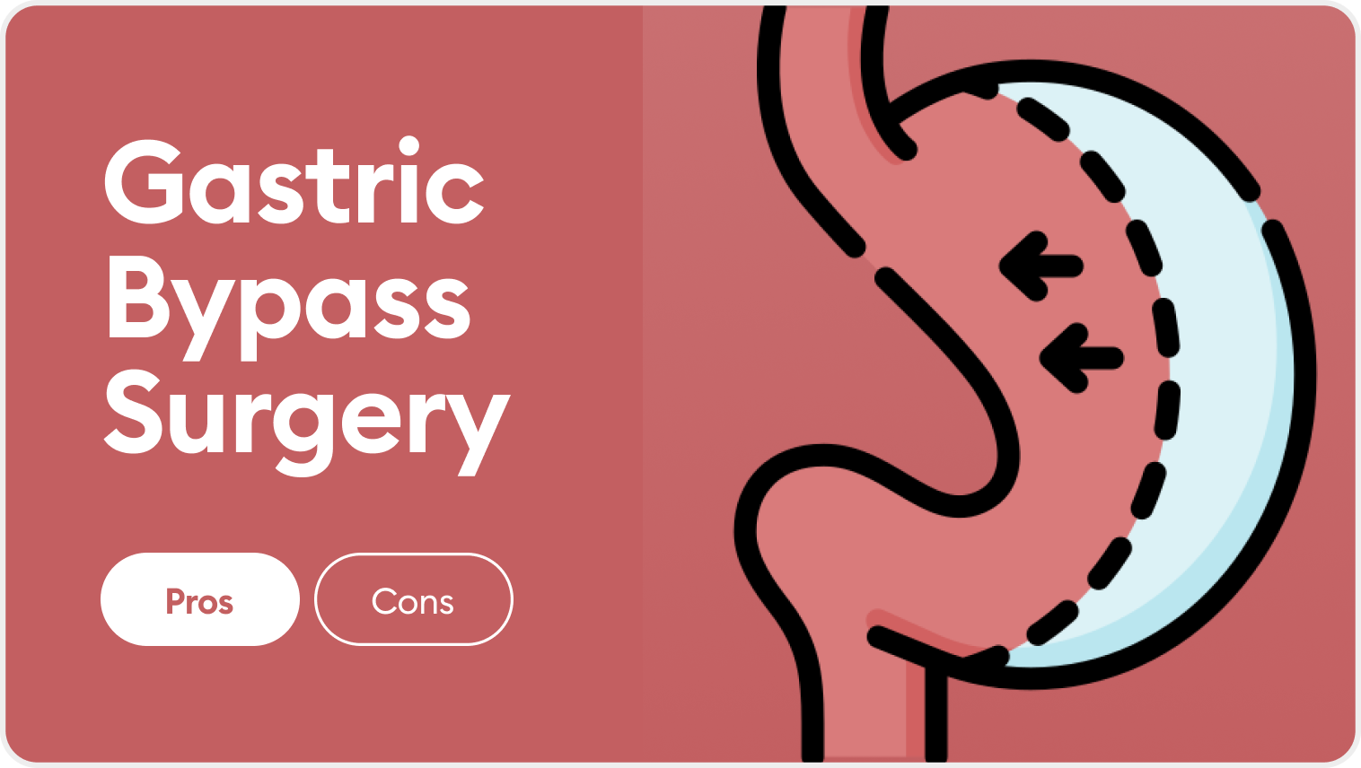 Gastric Bypass Pros Cons